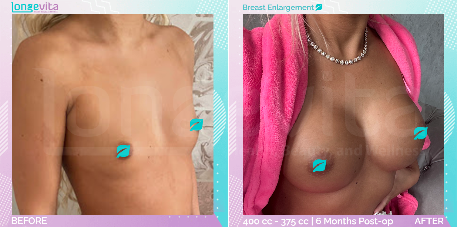 Breast Enlargement before and after, Breast, 20s female patient