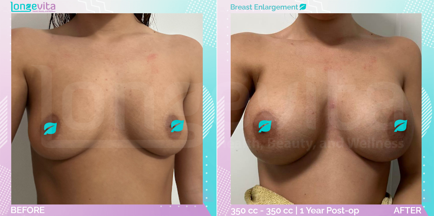 Breast Enlargement before and after, Breast, 20s female patient