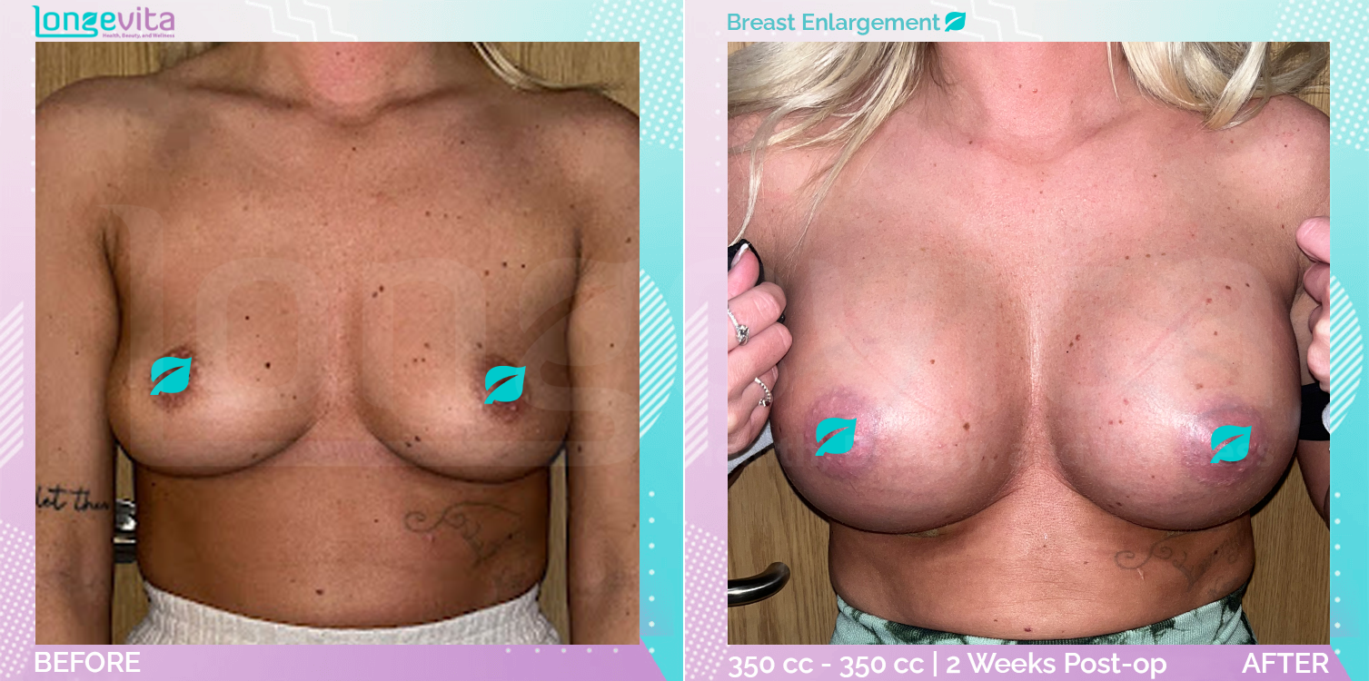 Breast Enlargement before and after, Breast, 30s female patient