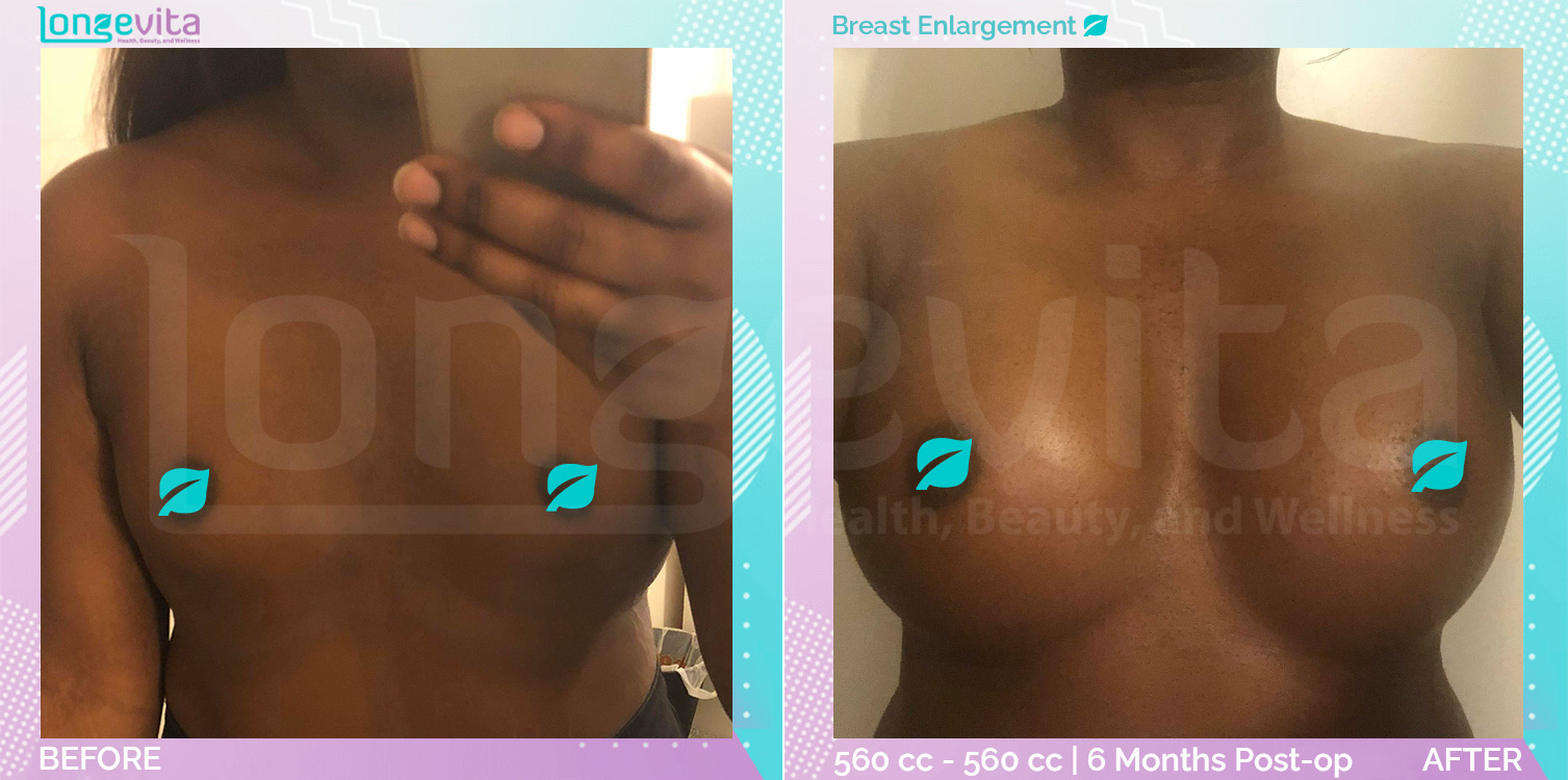 Breast Enlargement before and after, Breast, 30s female patient