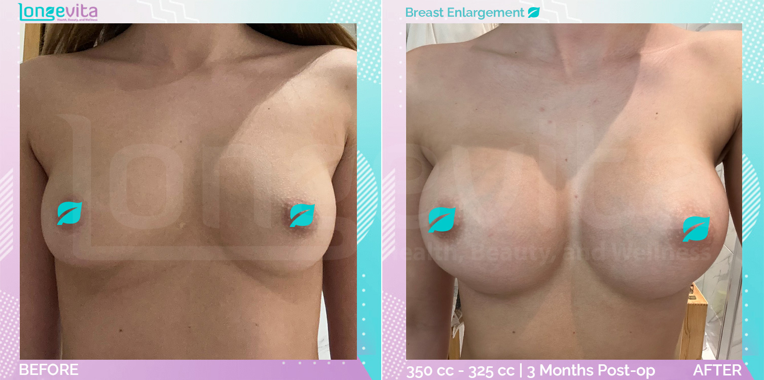 Breast Enlargement before and after, Breast, 20s female patient