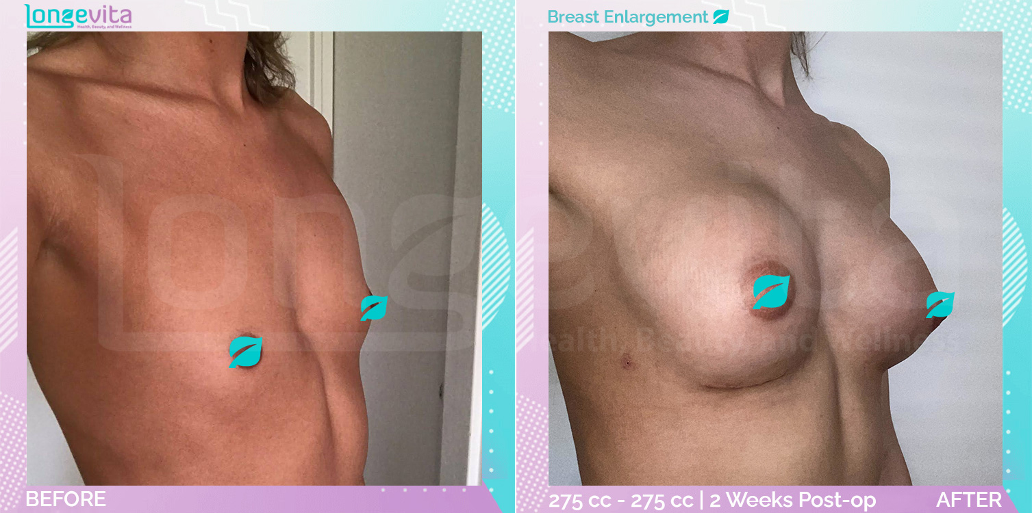 Breast Enlargement before and after, Breast, 20s female patient