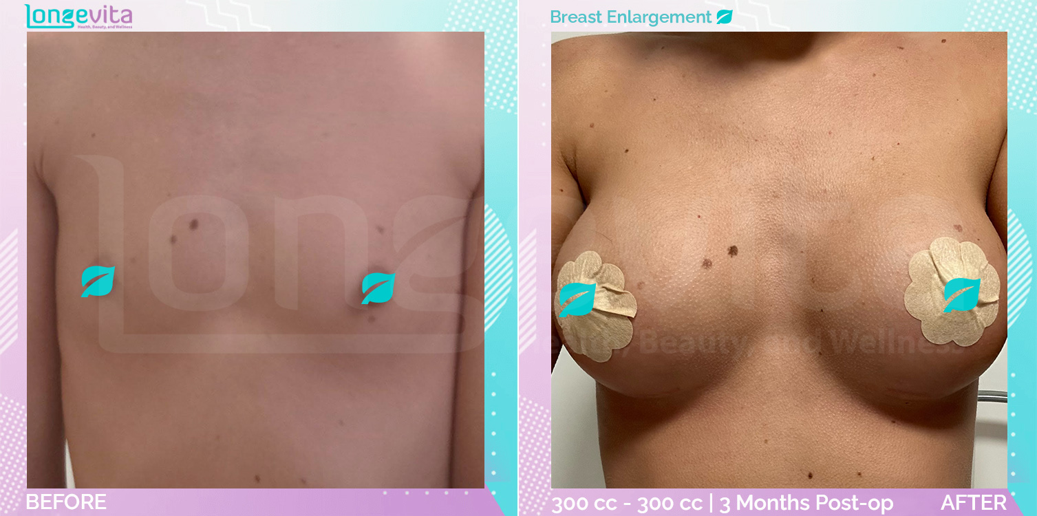 Breast Enlargement before and after, Breast, 20s female patient