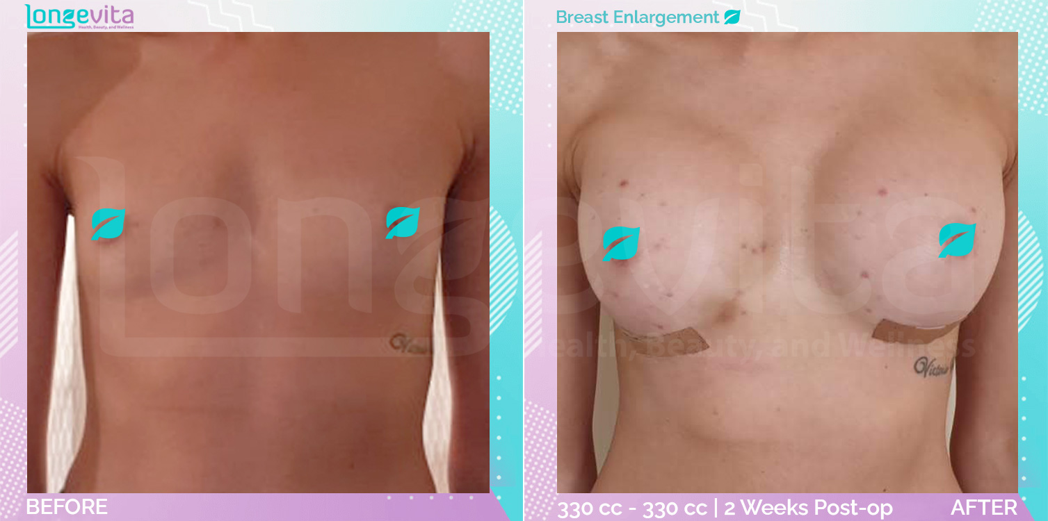 Breast Enlargement before and after, Breast, 20s female patient