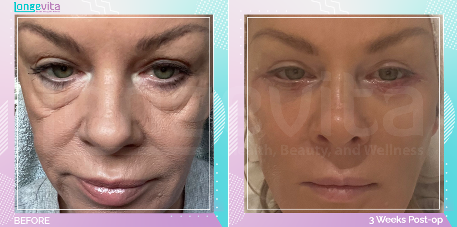 Eyelid and Facelift before and after, Face