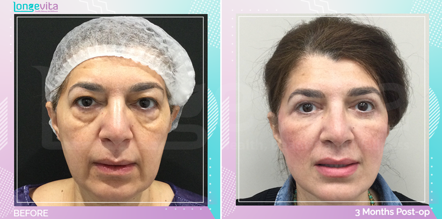 Eyelid and Facelift before and after, Face
