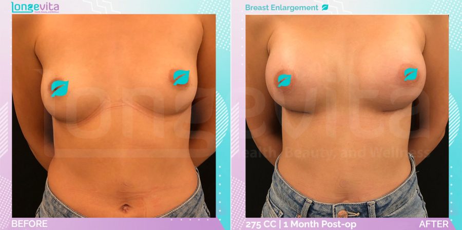 Breast Reduction before and after, Breast