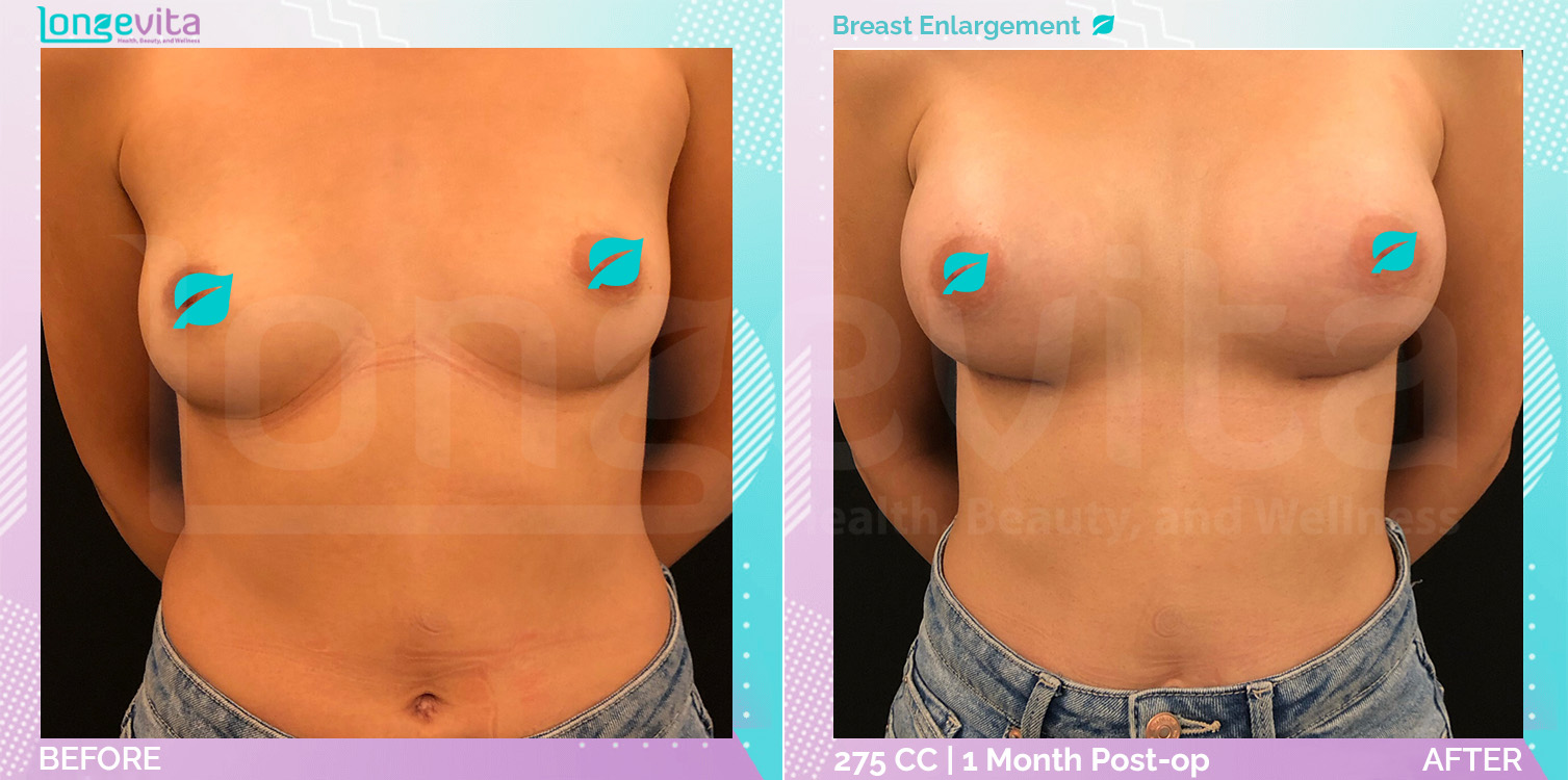 Breast Reduction before and after, Breast