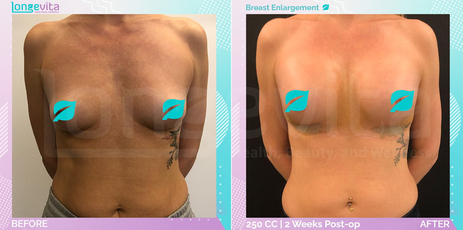 Breast Enlargement before and after, Breast