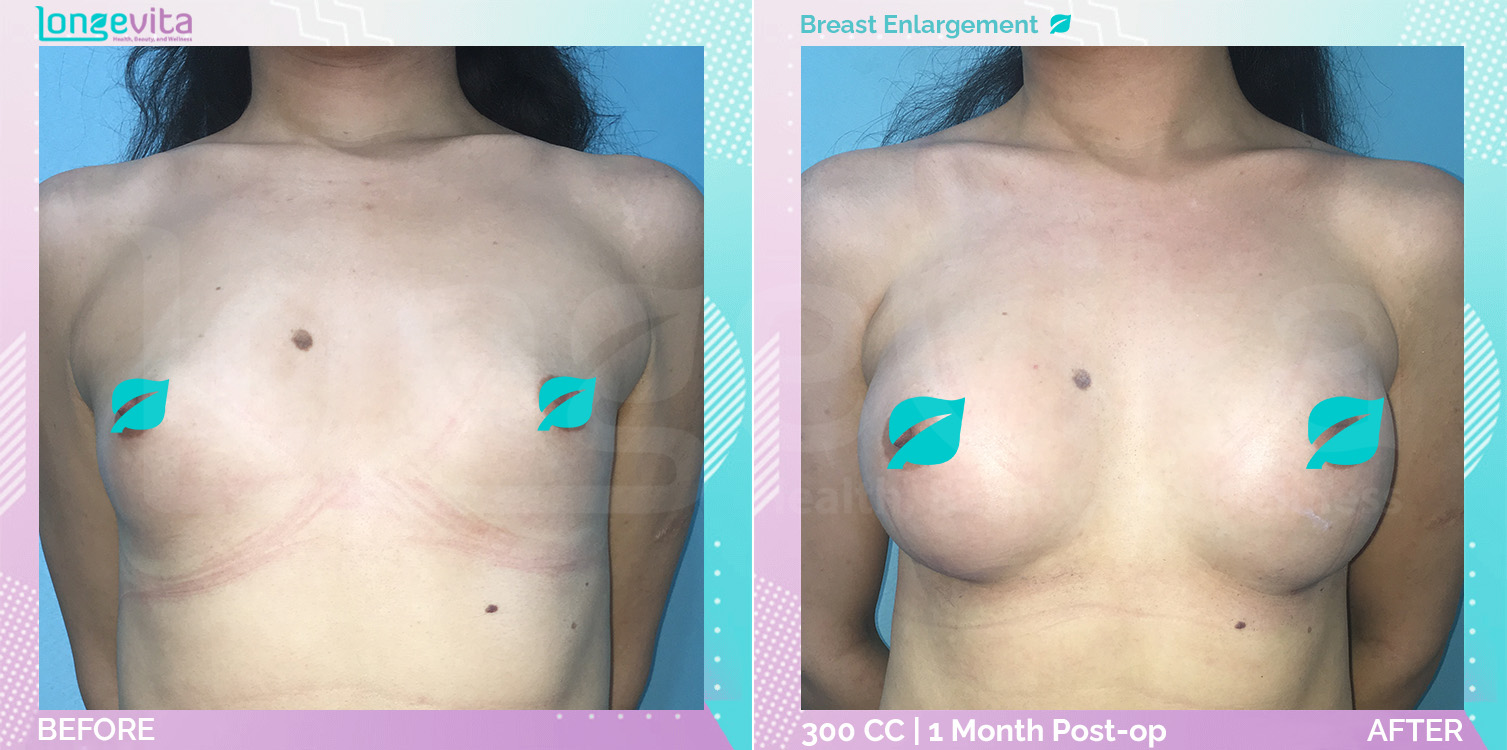 Breast Enlargement before and after, Breast