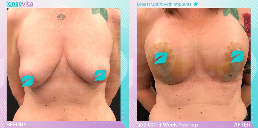 Breast Enlargement and Breast Lift before and after, Breast