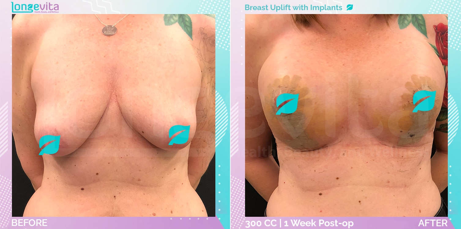 Breast Enlargement and Breast Lift before and after, Breast