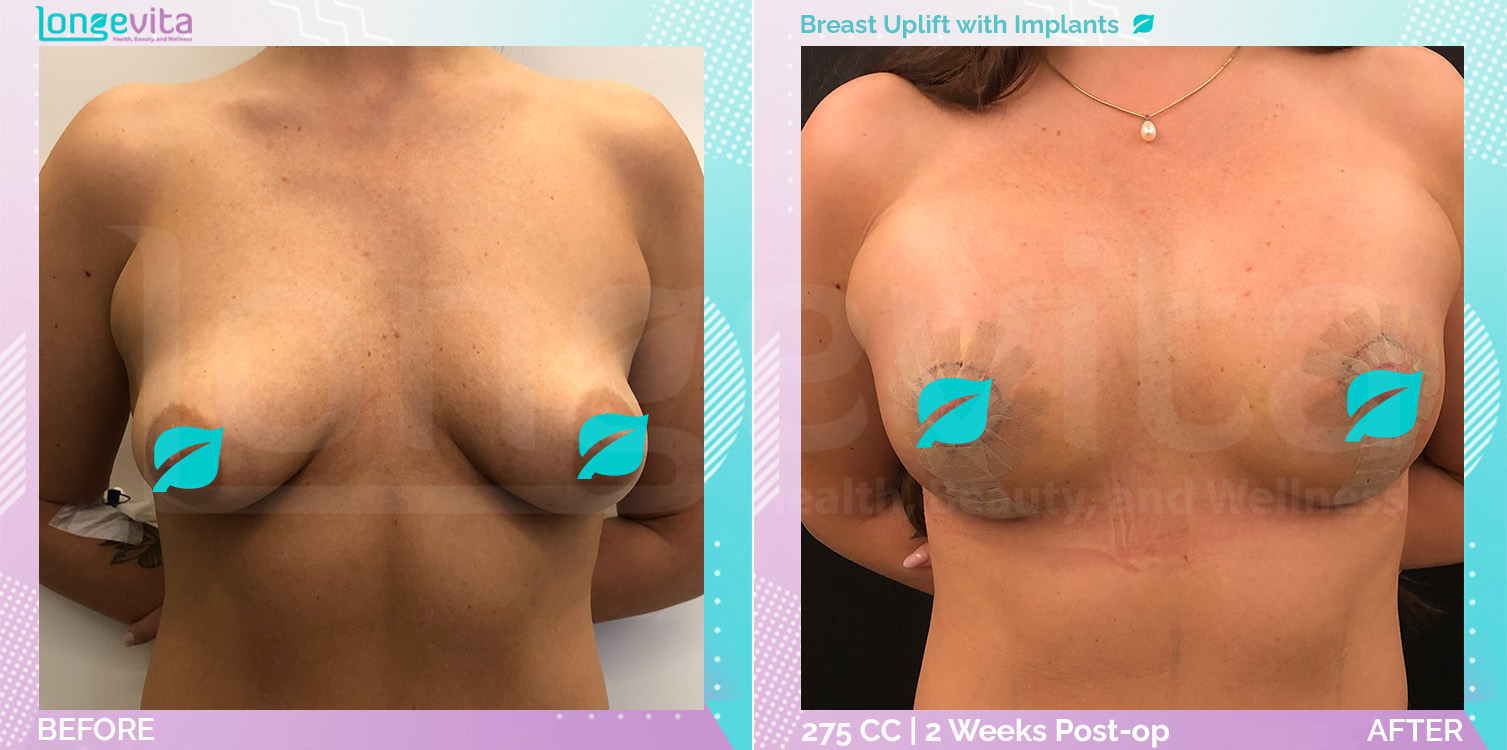 Breast Enlargement and Breast Lift before and after, Breast