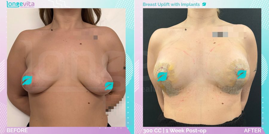 Breast Enlargement and Breast Lift before and after, Breast