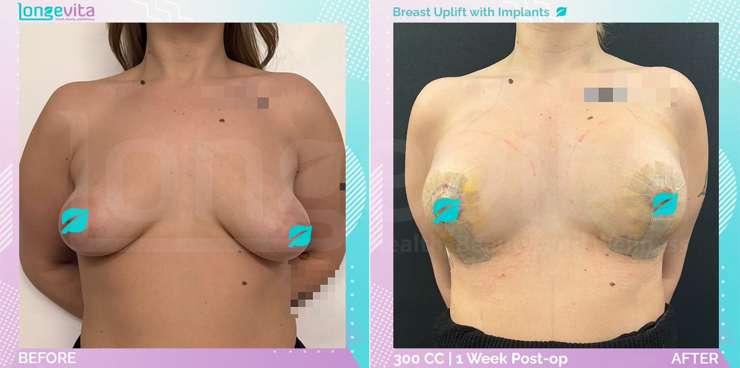 Breast Enlargement and Breast Lift before and after, Breast