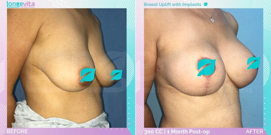 Breast Enlargement and Breast Lift before and after, Breast