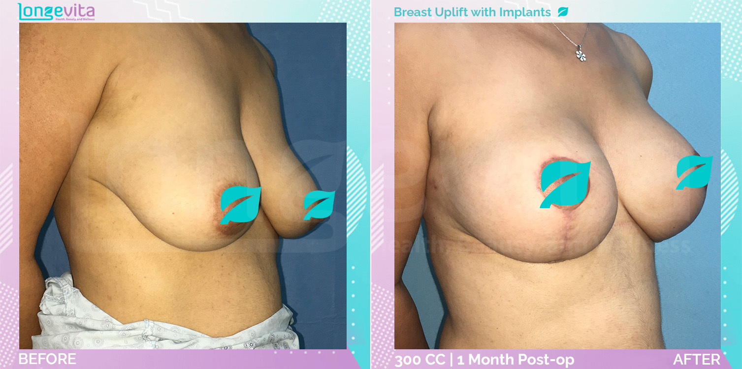 Breast Enlargement and Breast Lift before and after, Breast