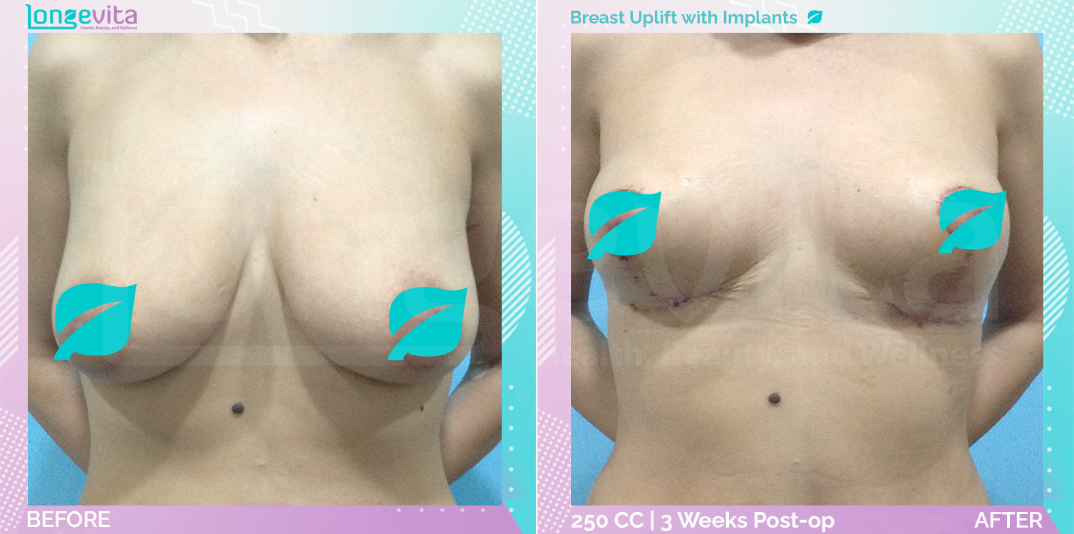 Breast Enlargement and Breast Lift before and after, Breast