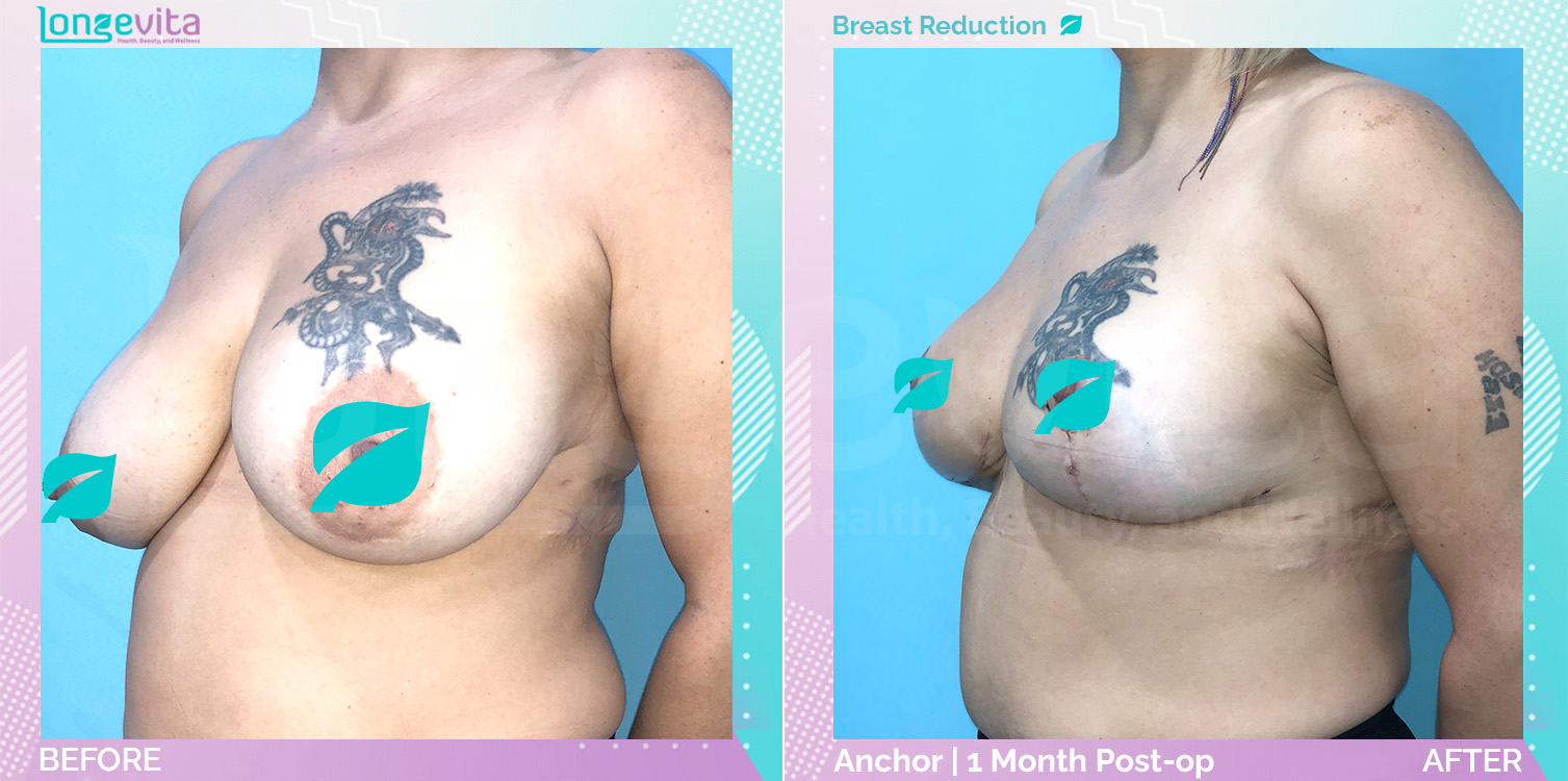 Breast Reduction before and after, Breast
