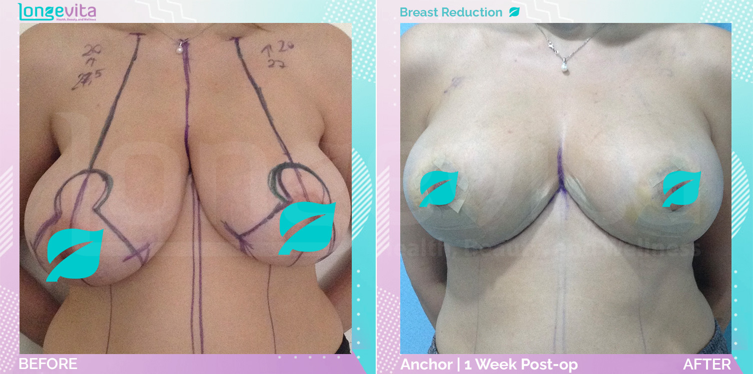 Breast Reduction before and after, Breast