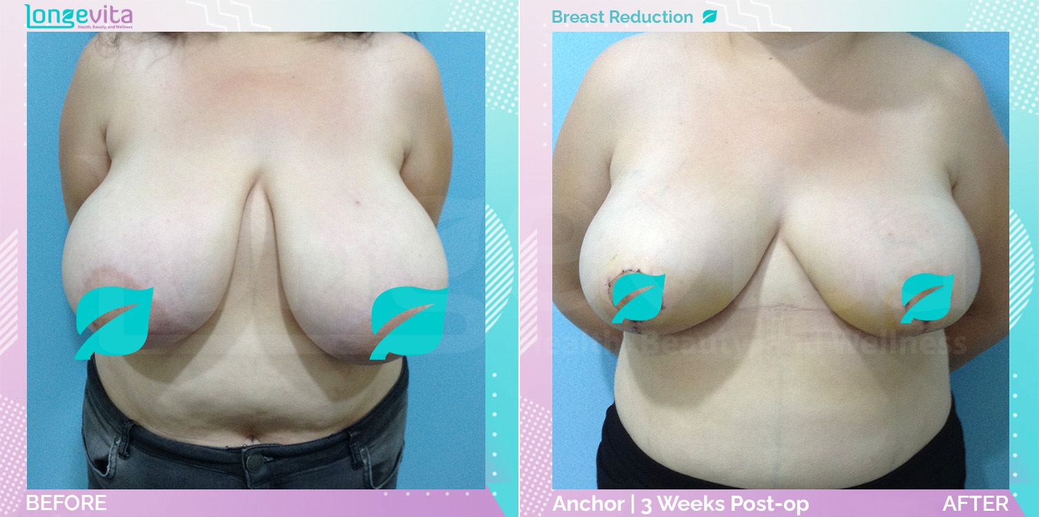 Breast Reduction before and after, Breast