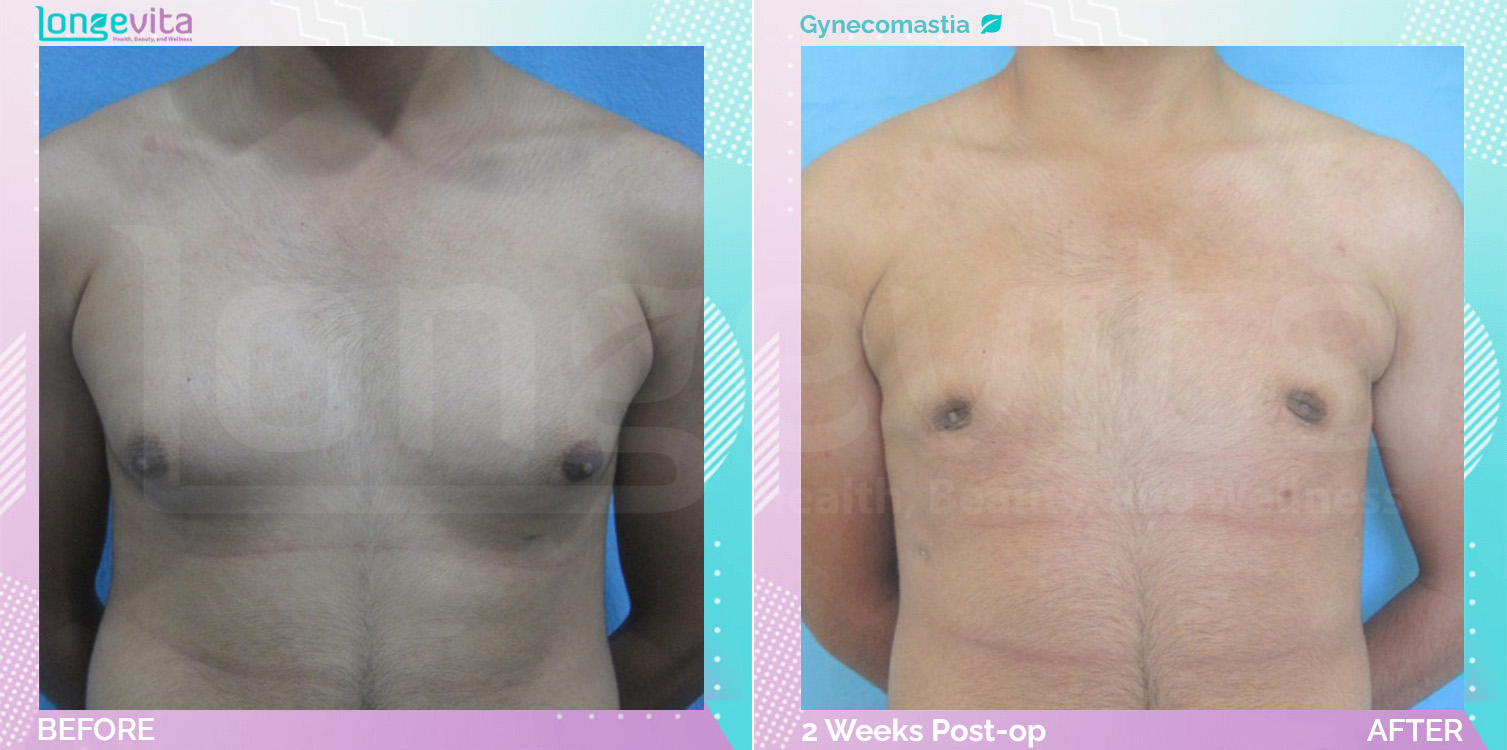 Gynecomastia before and after, Breast