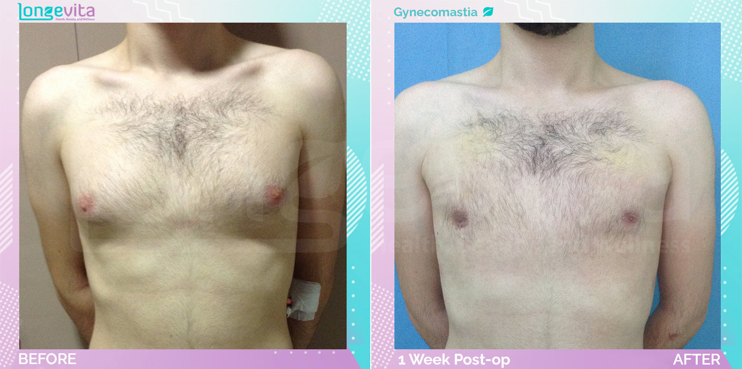 Gynecomastia before and after, Breast