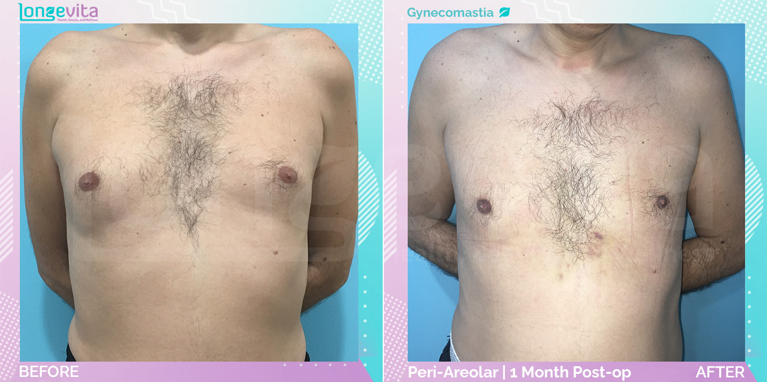 Gynecomastia before and after, Breast