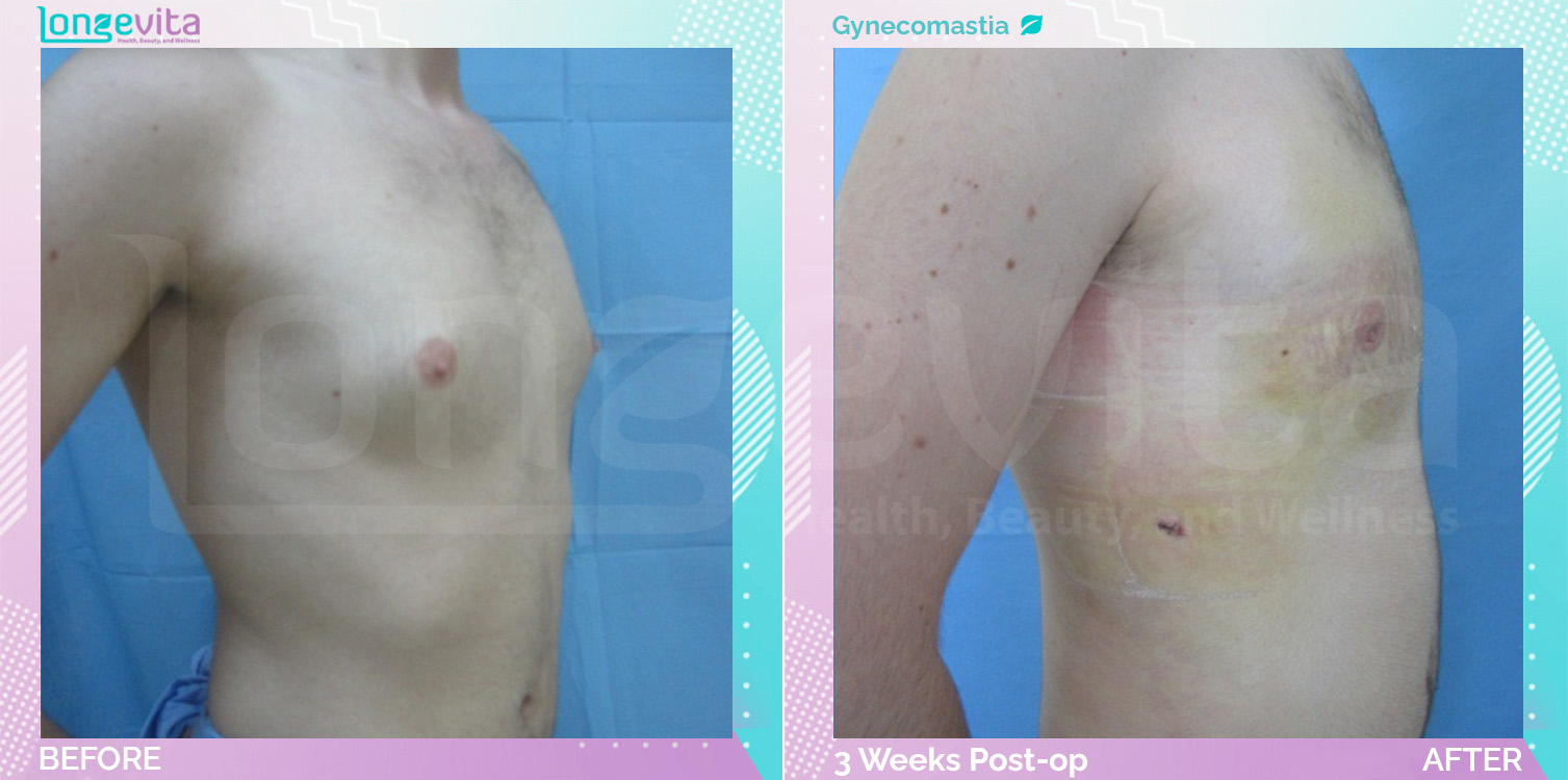 Gynecomastia before and after, Breast