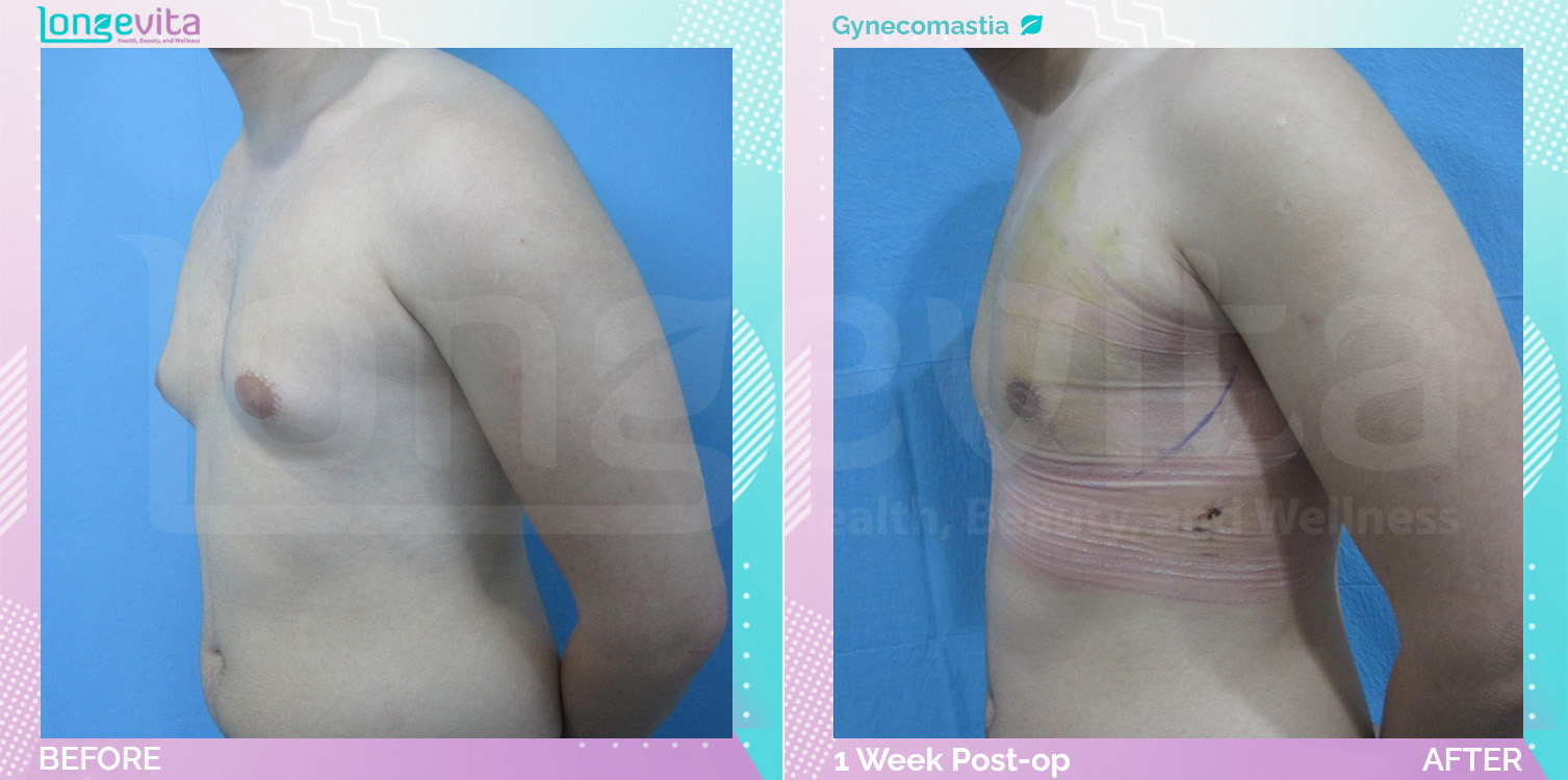 Gynecomastia before and after, Breast