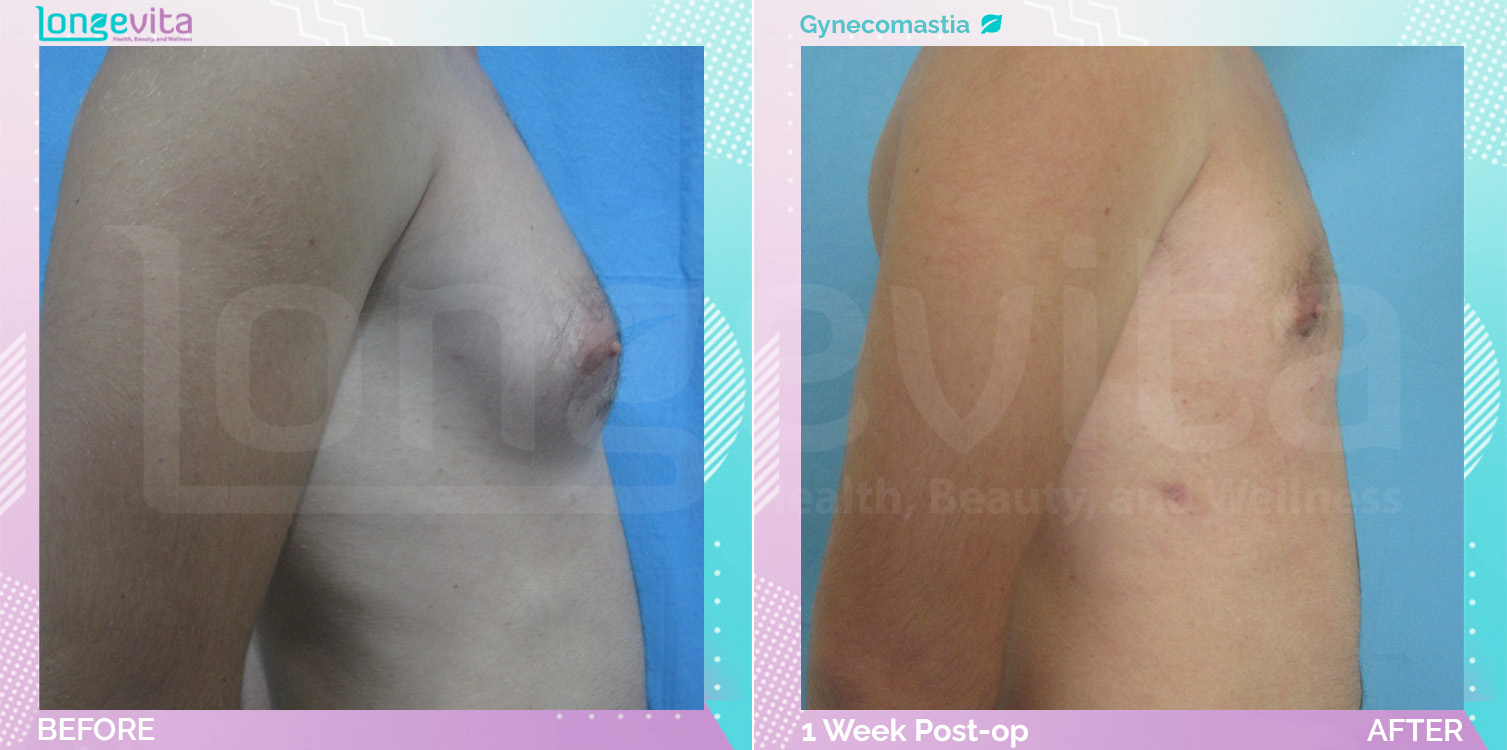 Gynecomastia before and after, Breast