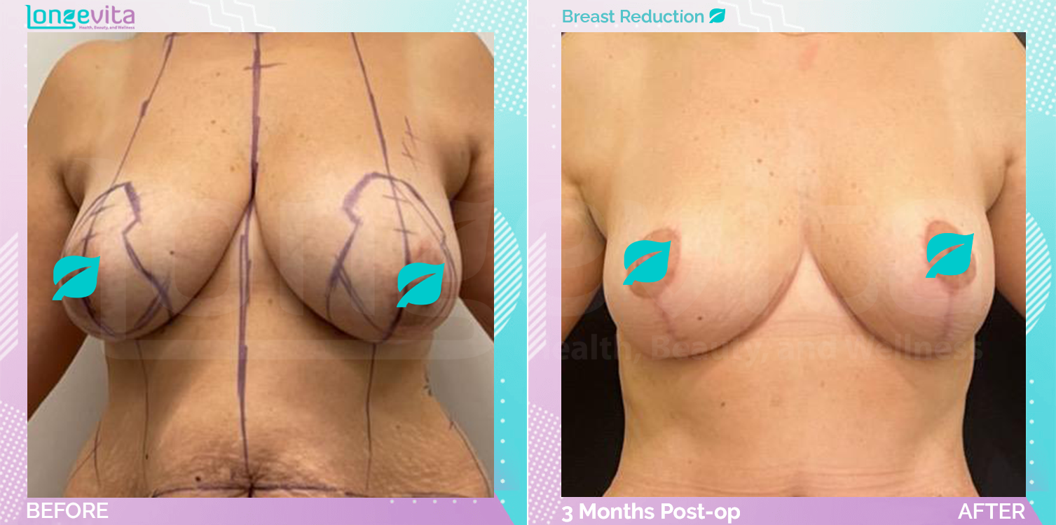 Breast Reduction before and after, Breast