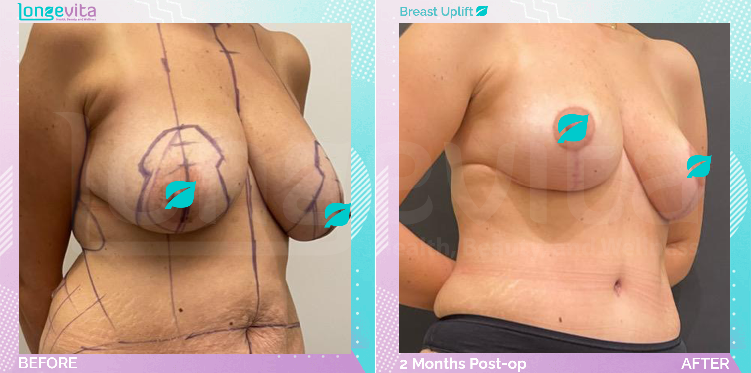 Breast Lift before and after, Breast