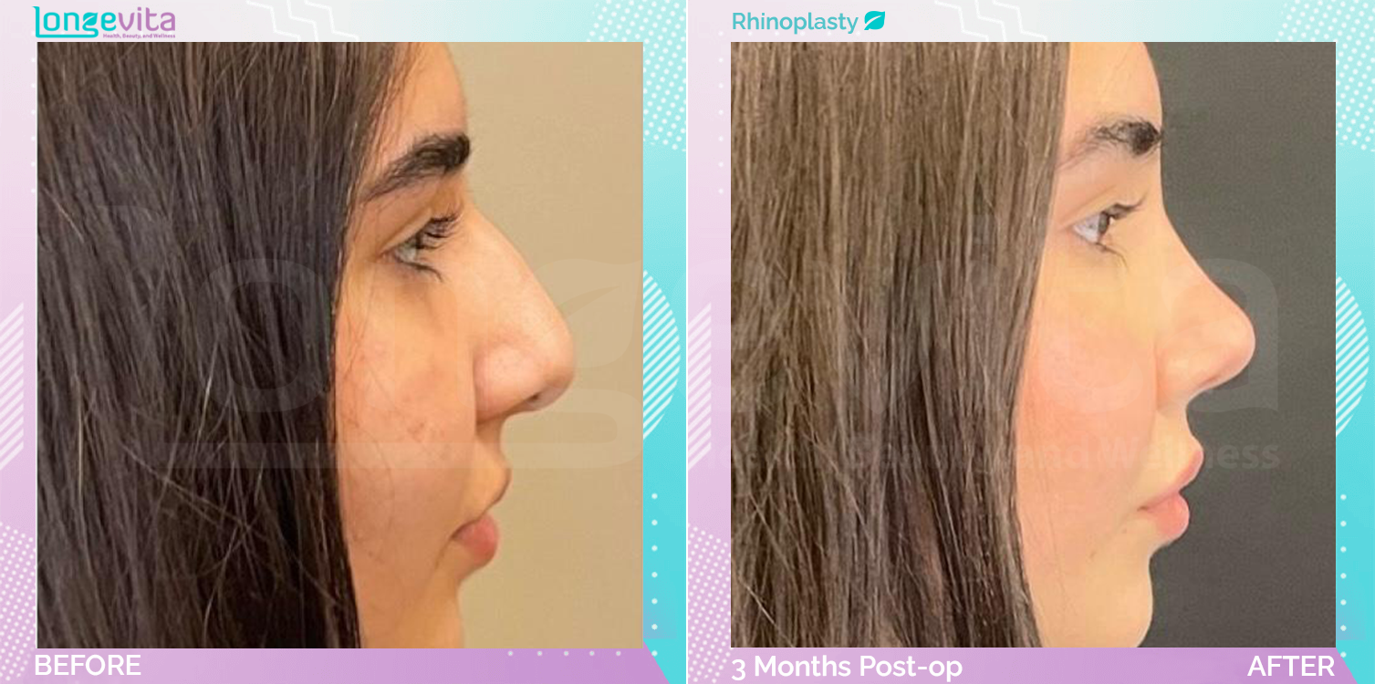 Rhinoplasty before and after, Face