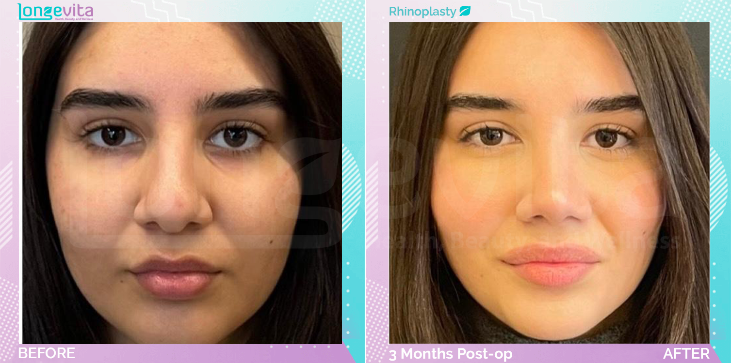 Rhinoplasty before and after, Face