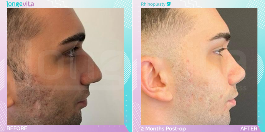 Rhinoplasty before and after, Face