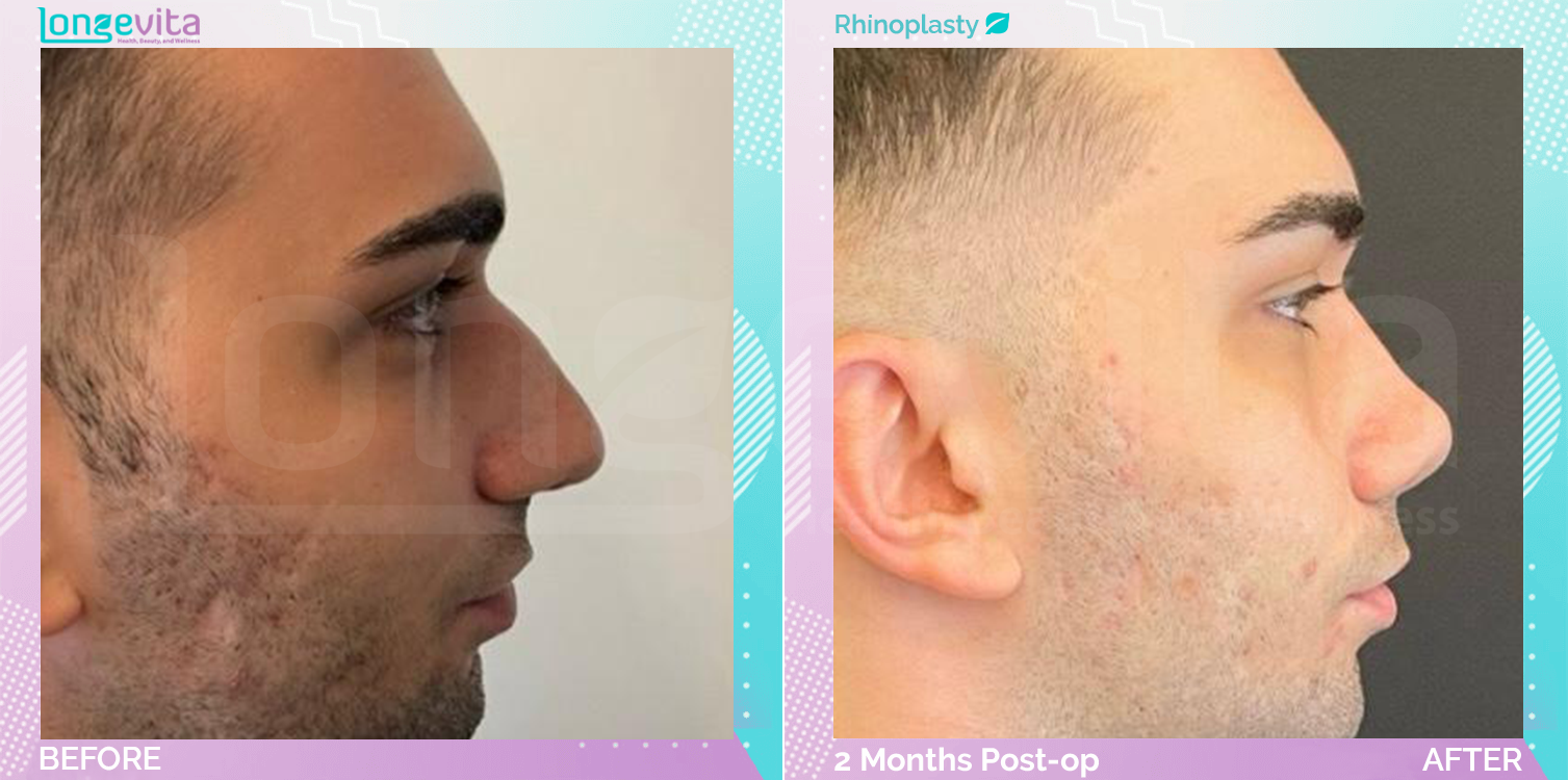 Rhinoplasty before and after, Face