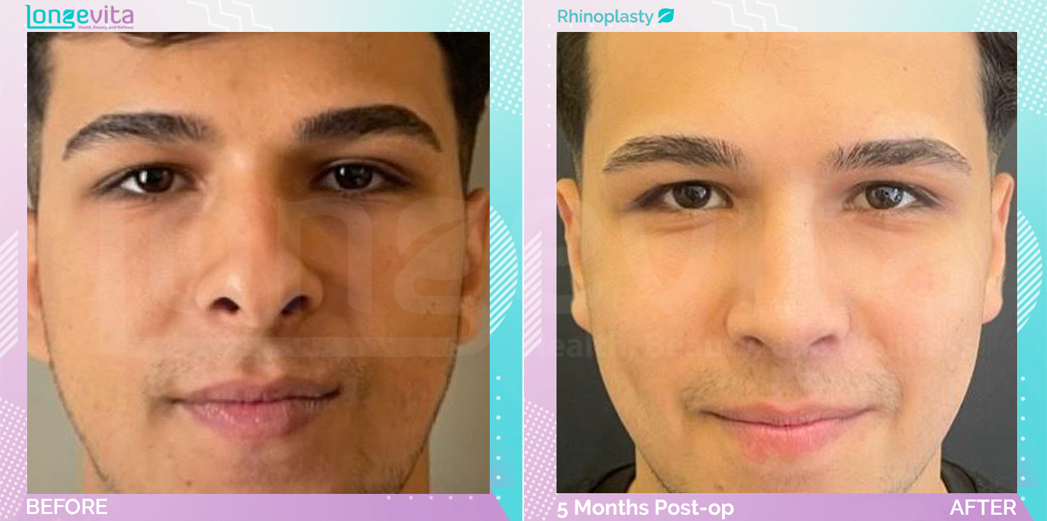 Rhinoplasty before and after, Face