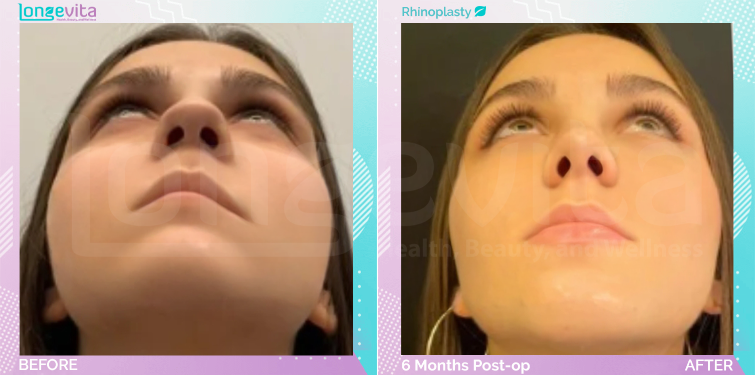 Rhinoplasty before and after, Face