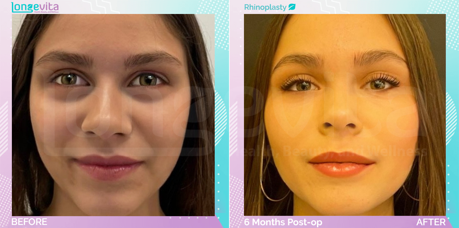 Rhinoplasty before and after, Face