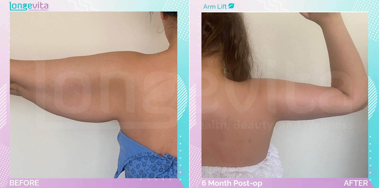 Arm Lift before and after, Body