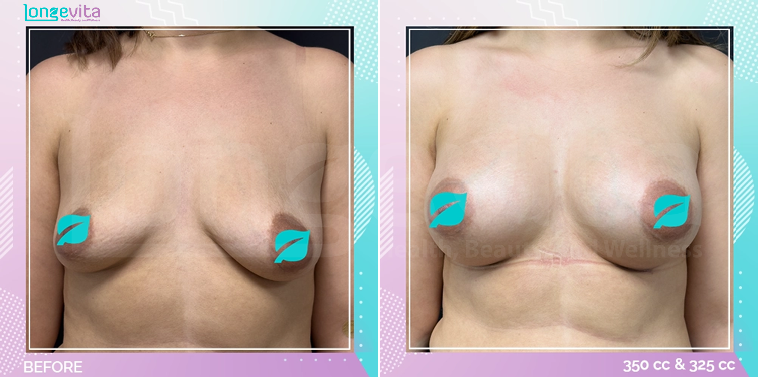 Breast Enlargement before and after, Breast