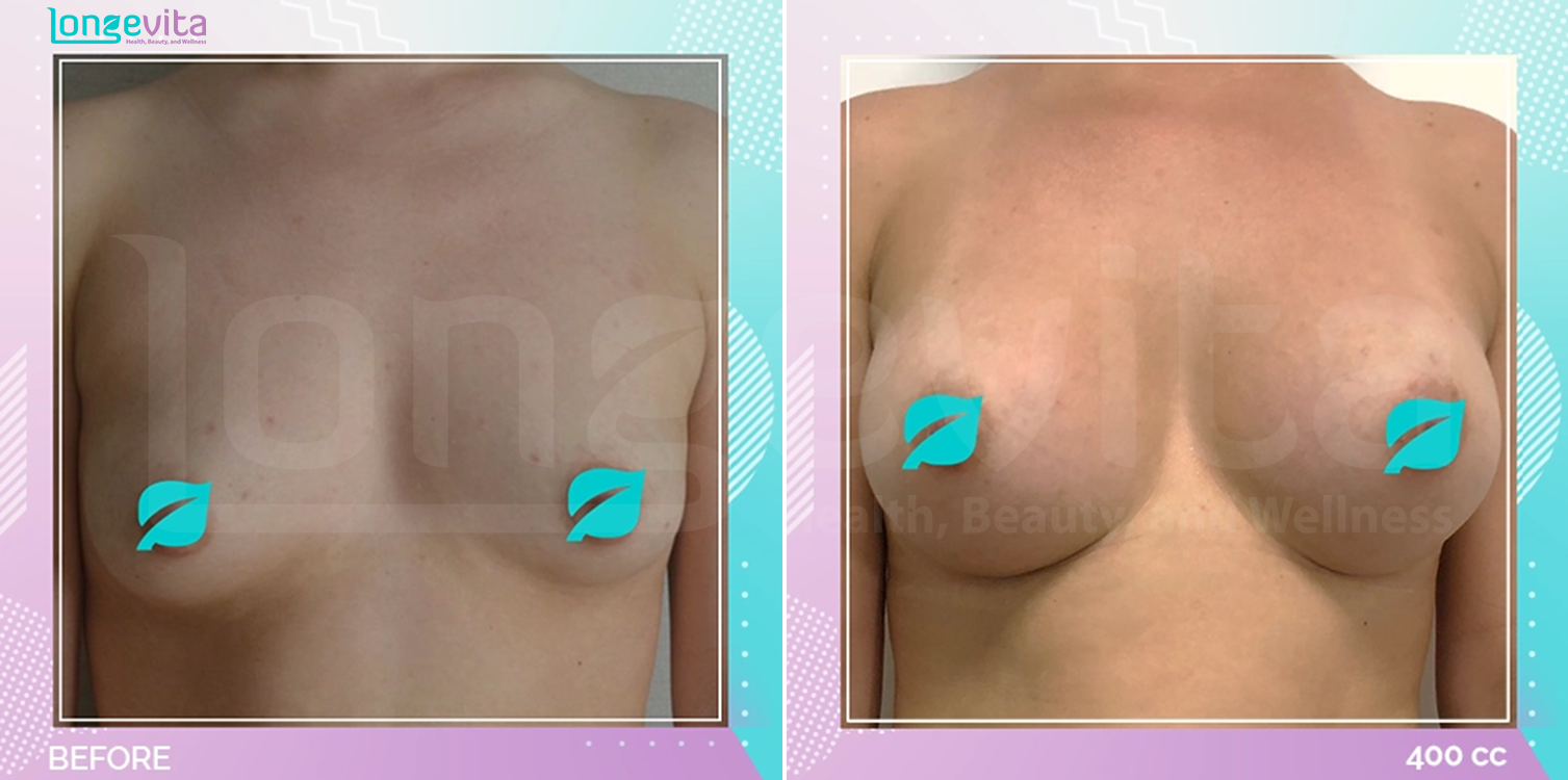 Breast Enlargement before and after, Breast