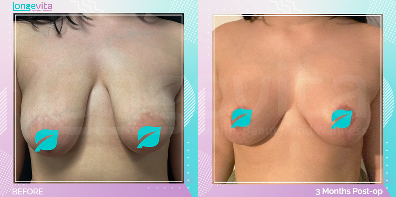 Breast Lift before and after, Breast