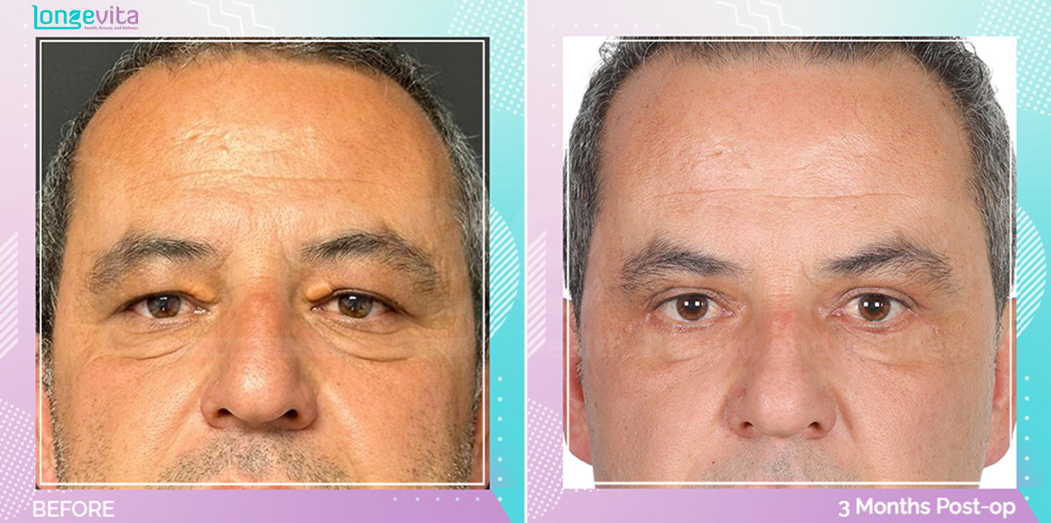 Eyelid before and after, Face