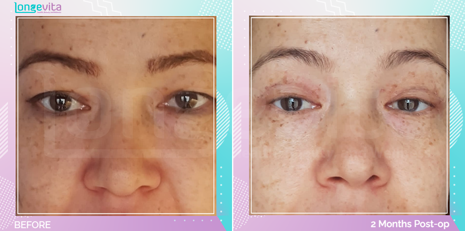 Eyelid before and after, Face