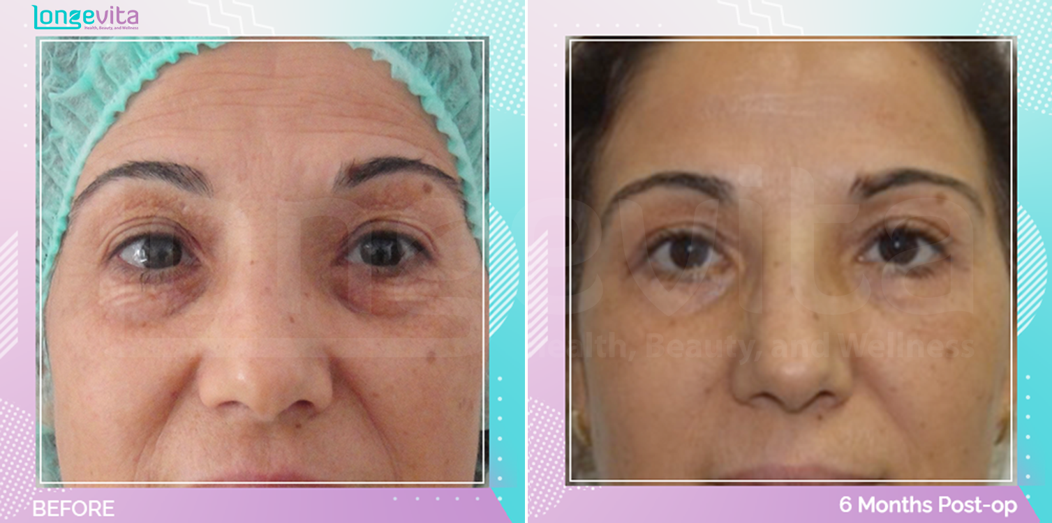 Eyelid before and after, Face