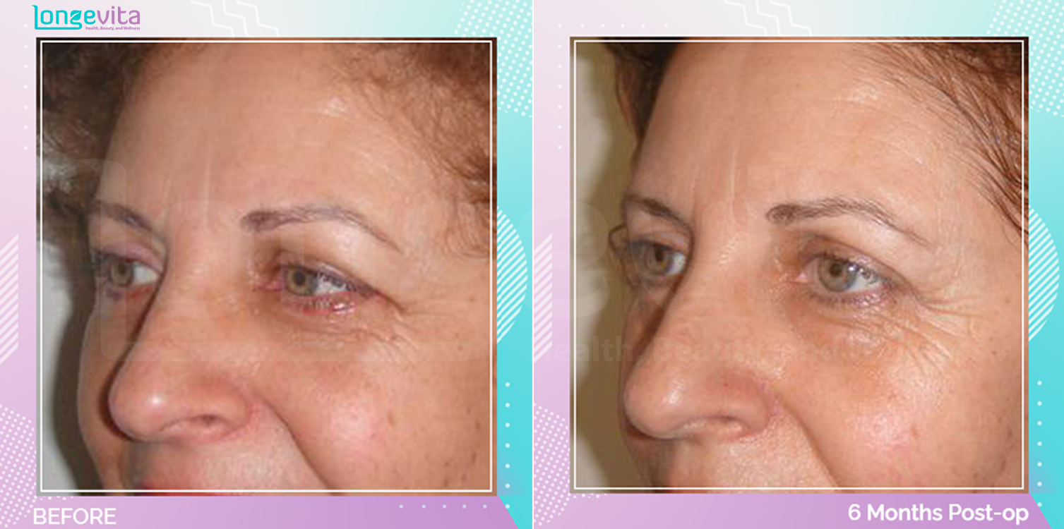 Eyelid before and after, Face