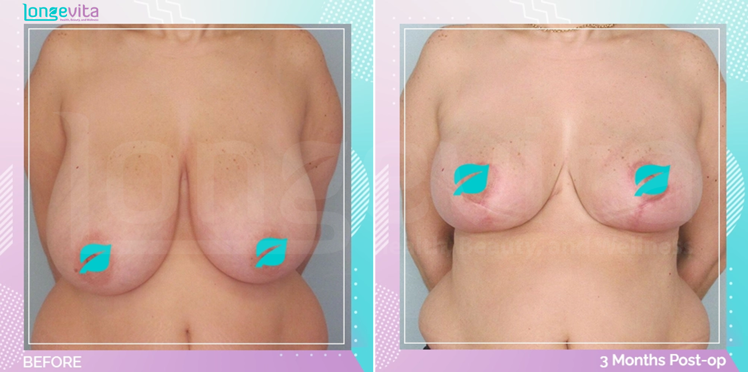 Breast Reduction before and after, Breast