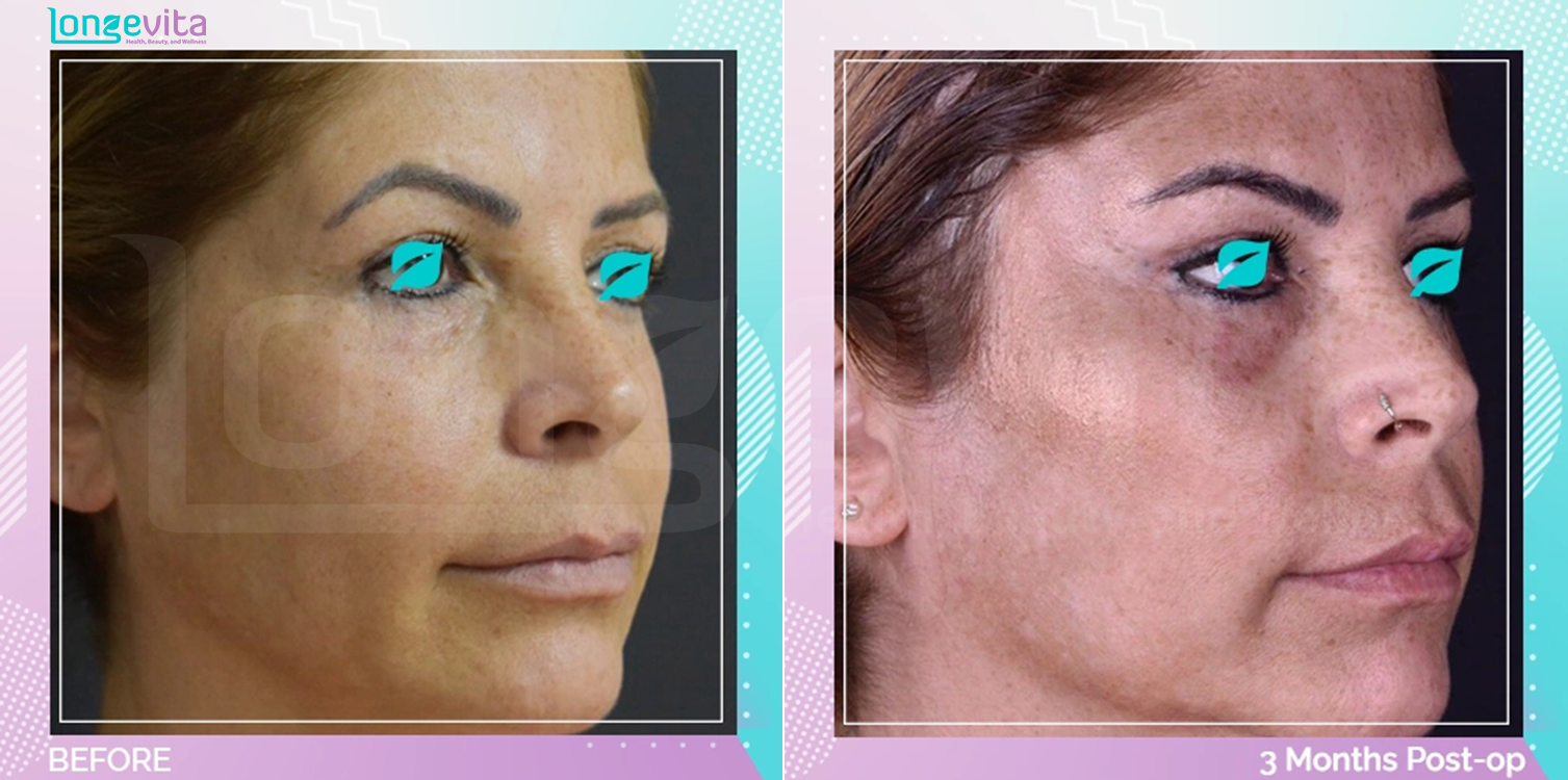 Facelift before and after, Face